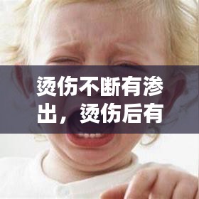 烫伤不断有渗出,烫伤后有渗出